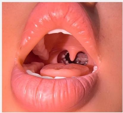 SILICONE OPEN JAW HEAD